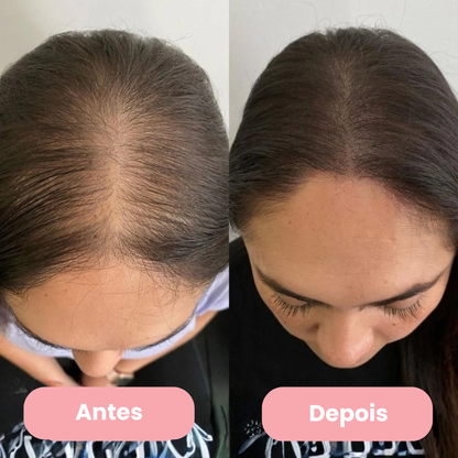 AlluHair - 4 tratamentos para queda de cabelo e fios fracos