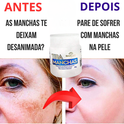 Allucream - Creme clareador de manchas [melasma & escurecimento da pele]  COMPRE 1 LEVE 2