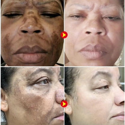 Allucream - Creme clareador de manchas [melasma & escurecimento da pele]  COMPRE 1 LEVE 2